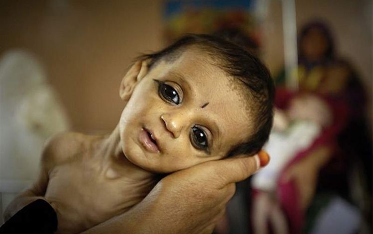 कुपोषण और चौकाने वाले आकंड़े - malnutrition and startling figures